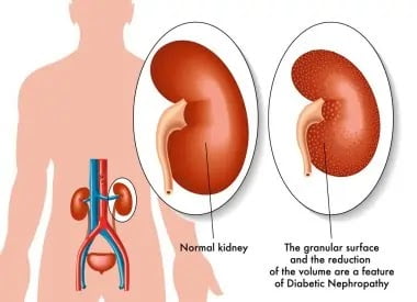 diabetic nephropathy