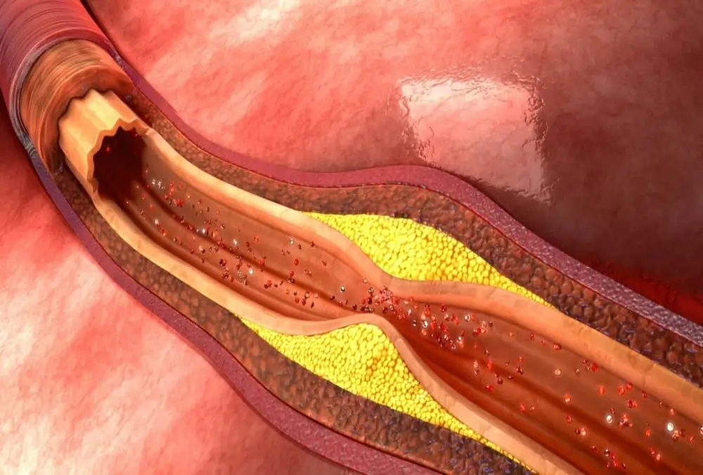 atherosclerosis